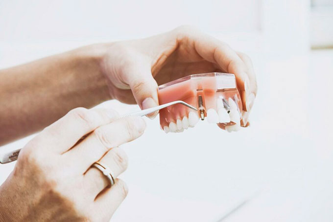 implantes-dentales-cuidado-1024x683