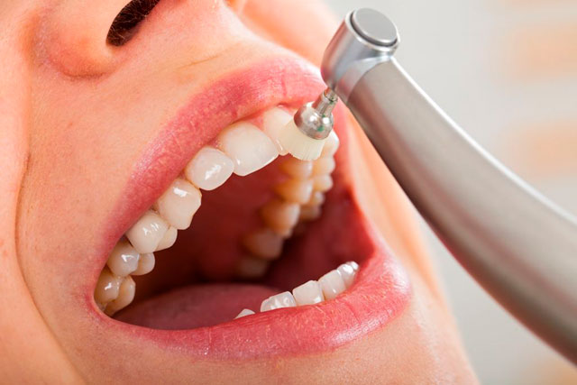 mantenimiento-periodontal