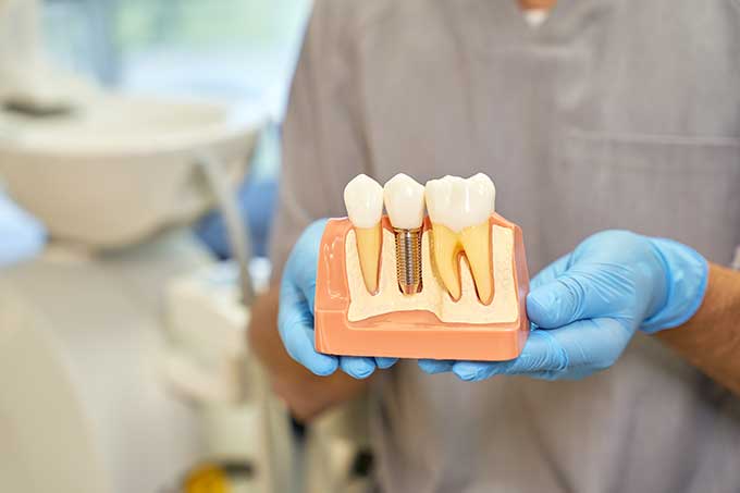 cuanto-cuestan-los-implantes-dentales