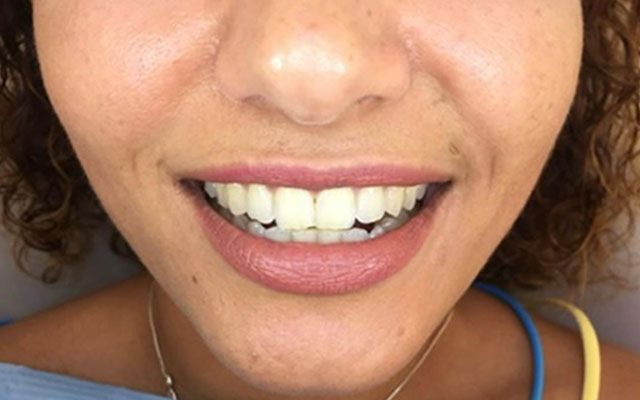 blanqueamiento-antes blanqueamiento-antes