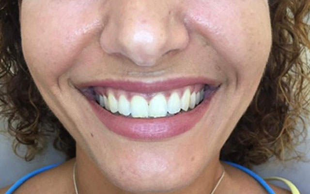 blanqueamiento-despues blanqueamiento-despues