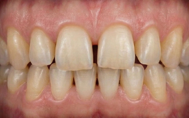 carillas-antes carillas-antes