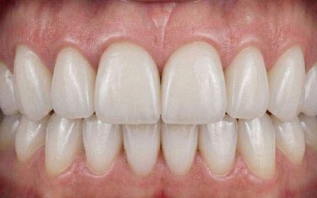 carillas-despues carillas-despues