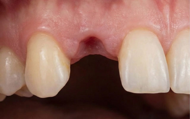 implante-antes implante-antes