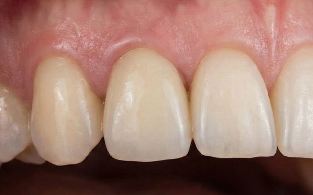 implante-despues implante-despues