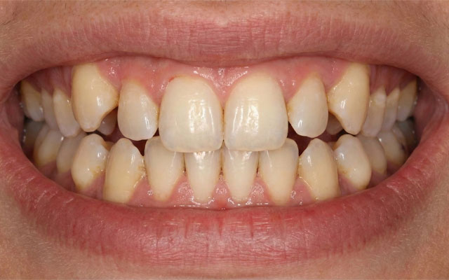 orto-invi-antes orto-invi-antes